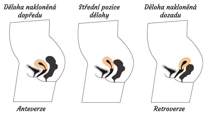 Tři různé varianty naklonění dělohy: dopředu, uprostřed či dozadu.