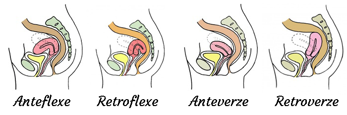Na obrázku níže vidíme čtyři varianty umístění dělohy.